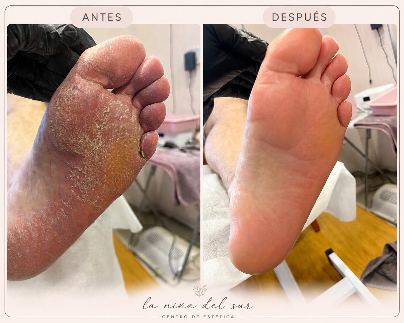 Pedicura profesional: antes y después de tratamiento de talones